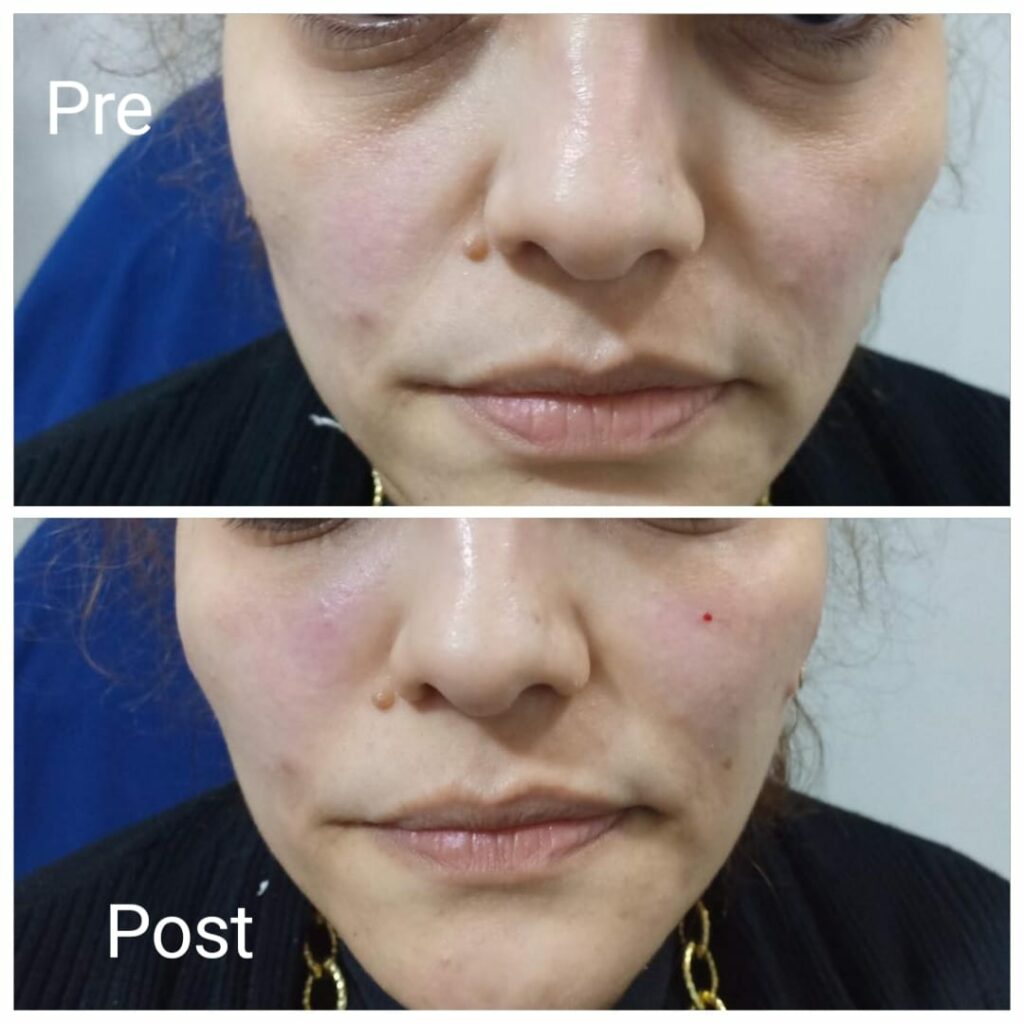 The best under eye plastic surgeon